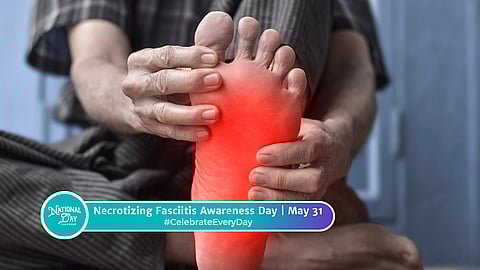 NECROTIZING FASCIITIS AWARENESS DAY  May 31