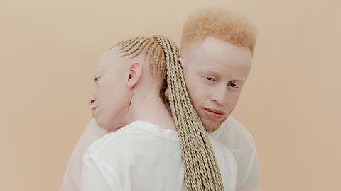 INTERNATIONAL ALBINISM AWARENESS DAY | June 13
